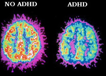 adhd